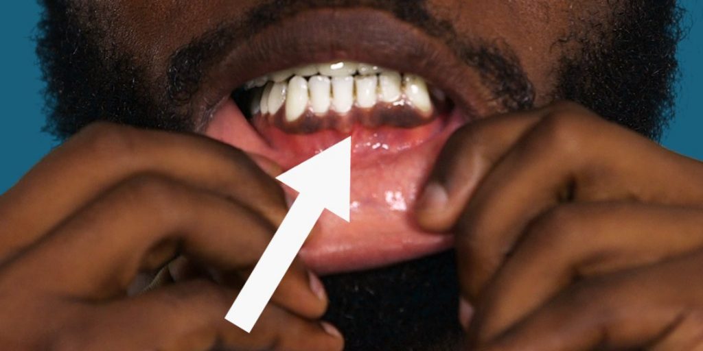 Quelles sont les causes des taches de dents sur les africains?