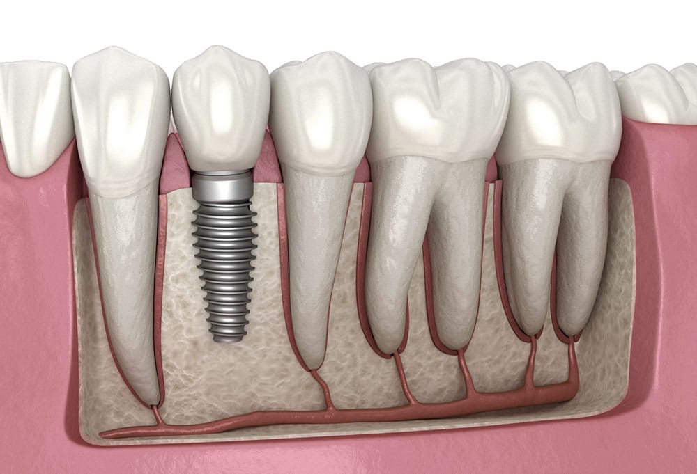 mettre les implants dentaires