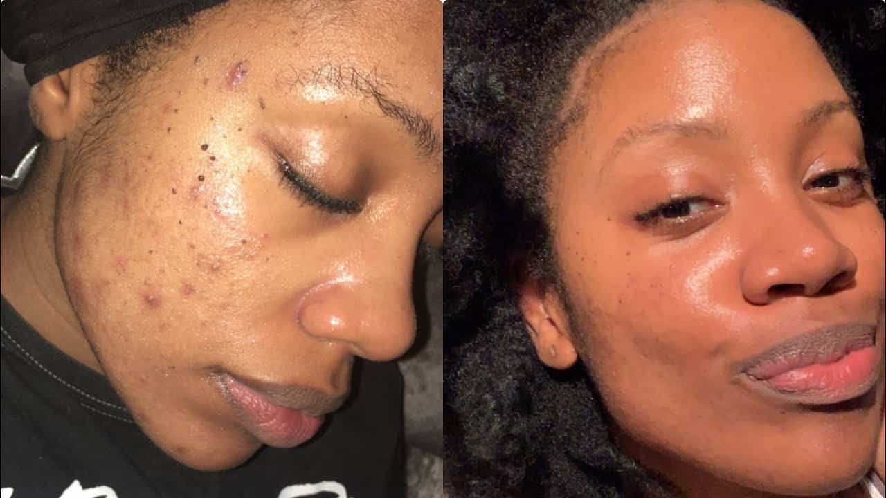 astuce contre poussées d'acné soudaines