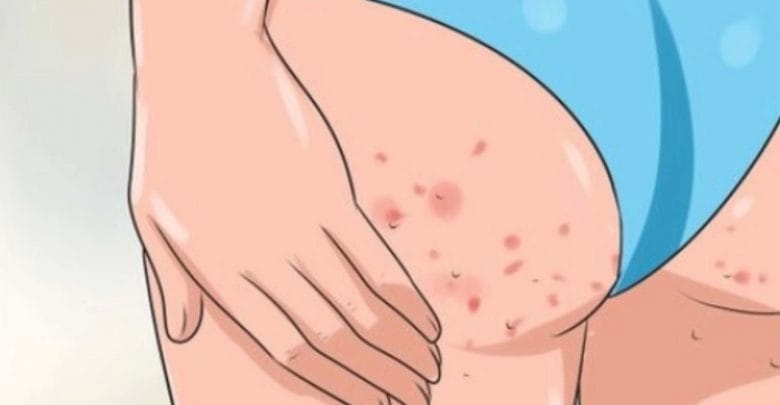 éliminer les boutons sur les fesses
