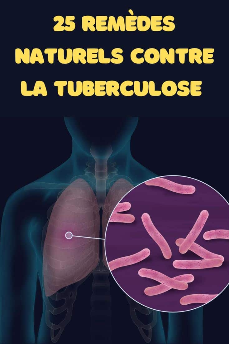 25 Remèdes naturels contre la tuberculose