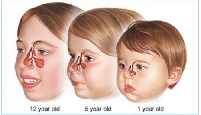 comment soigner une sinusite enfants