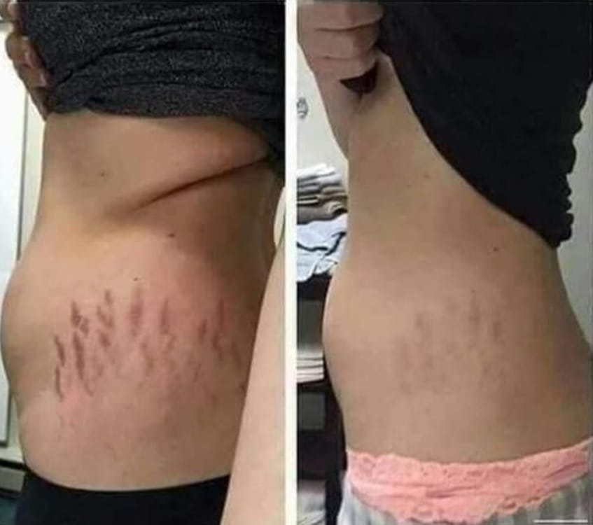 comment enlever les vergetures