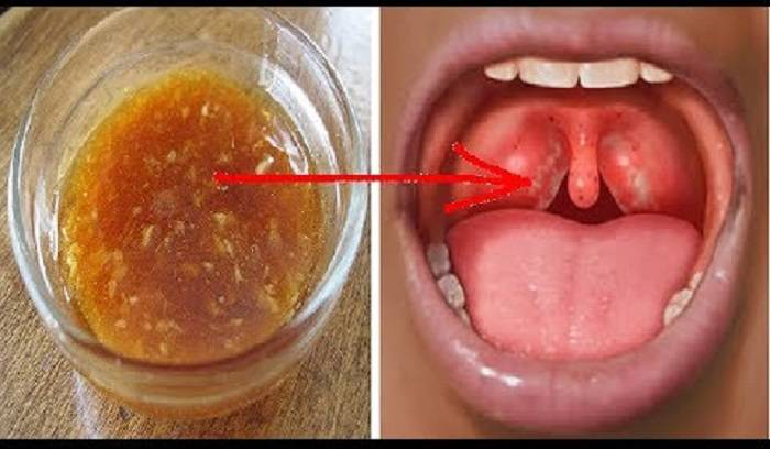 l'angine streptococcique remèdes naturel