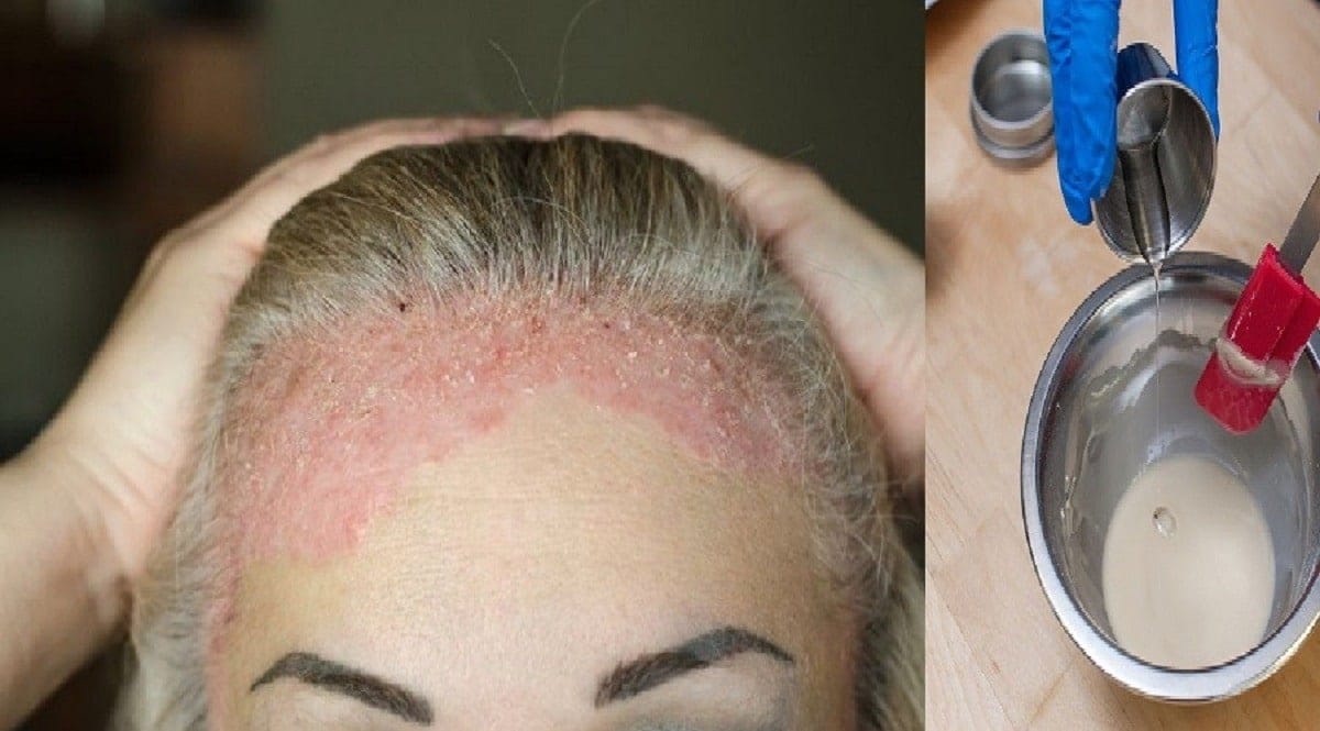 Pommade du psoriasis
