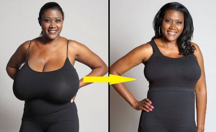 Réduire la taille des seins avant et après