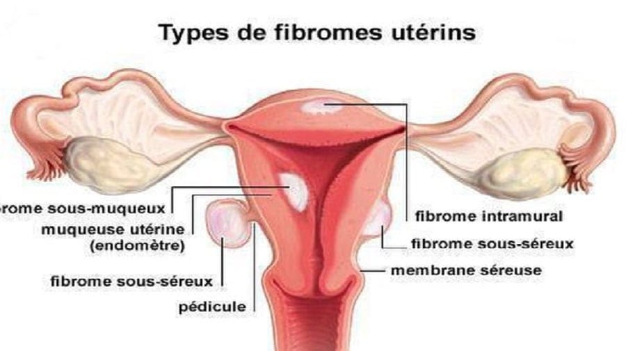 Fibrome Utérin