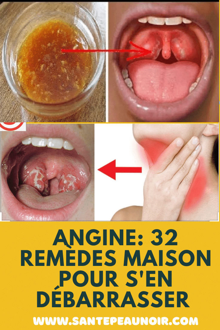 Mal De Gorge Et Angine | Symptôme D’Une Angine Chez L’Adulte – CREM