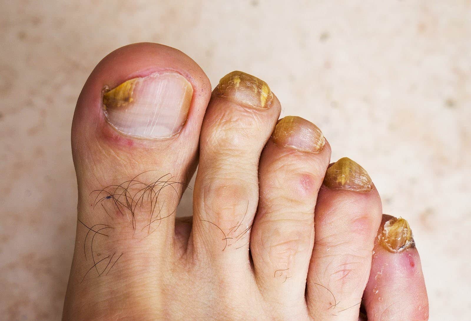 mycoses des ongles de pieds
