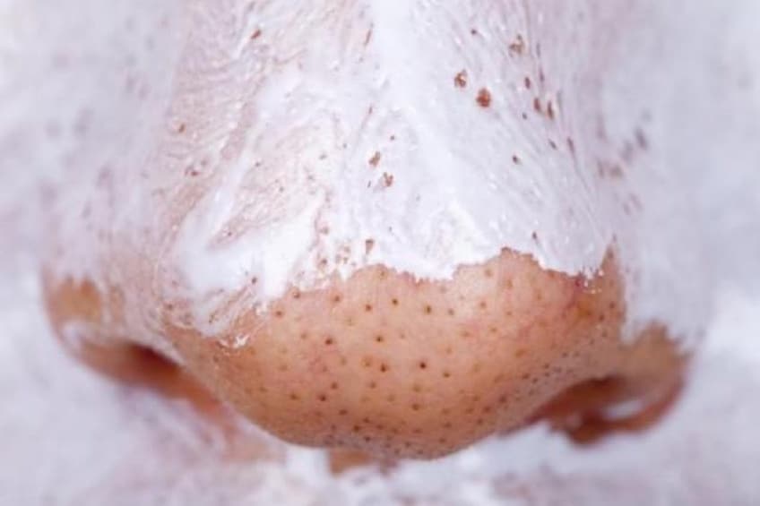 filaments sébacés sur le nez