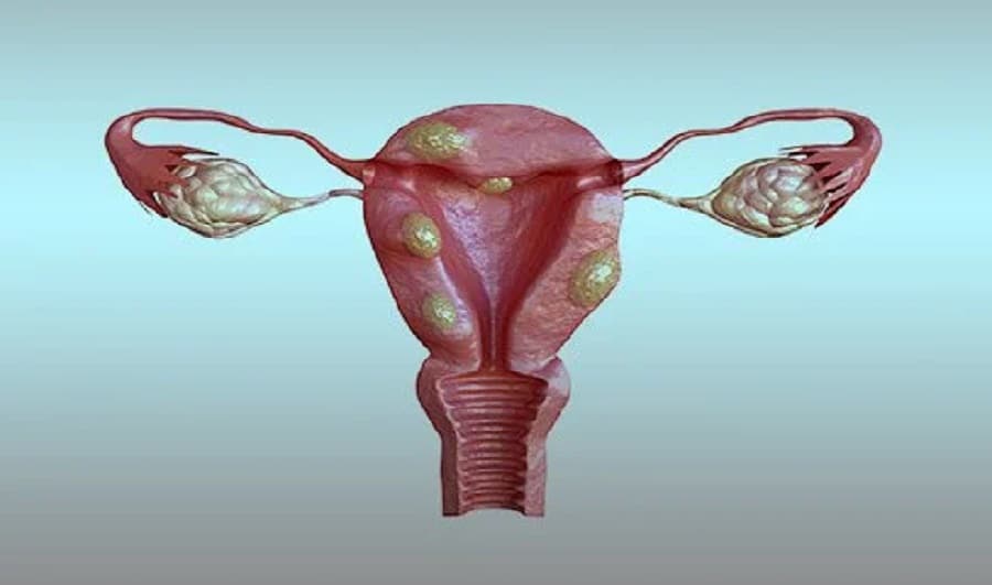 adénomyose dans l'uterus