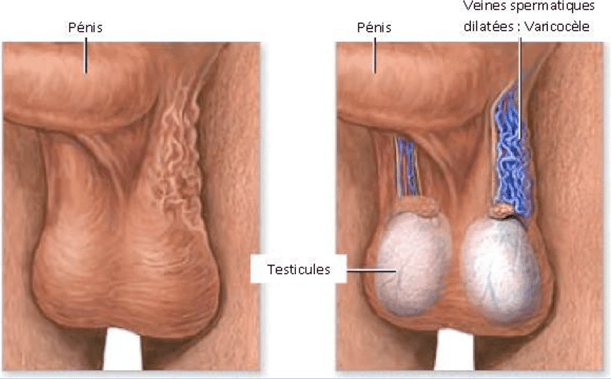 Image illustrant la varicocèle