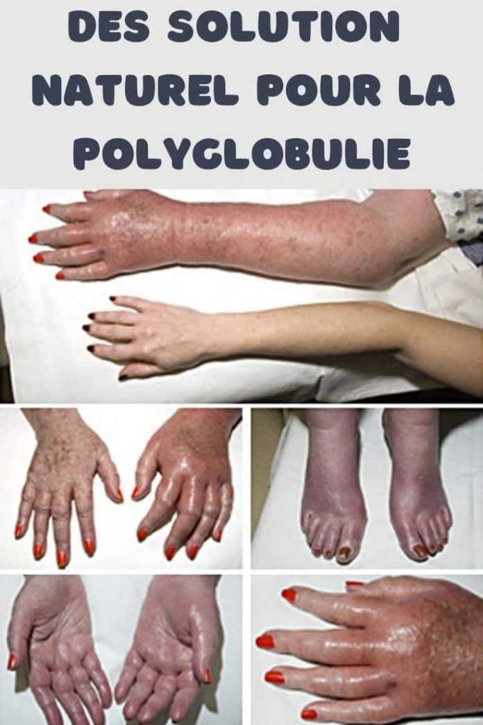polyglobulie traitement naturel