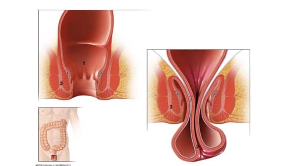 Traitement la rectocèle ou prolapsus rectal