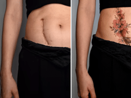 Tatouage sur les cicatrices photo avant et après
