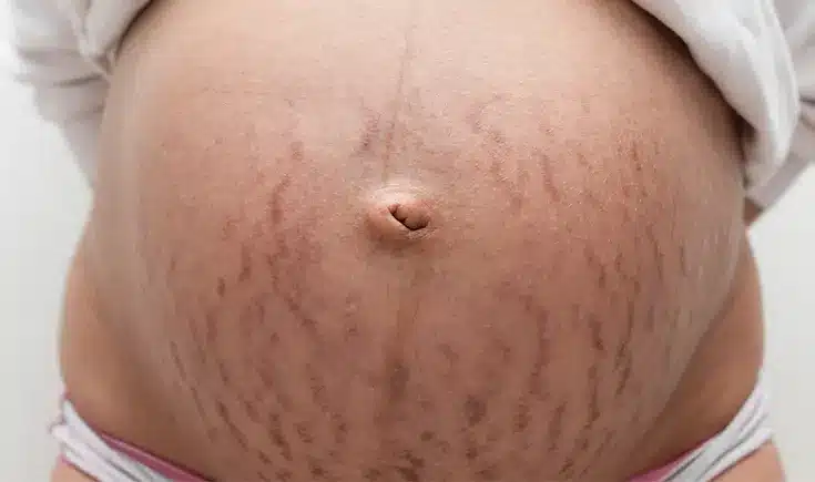 vergetures pendant la grossesse