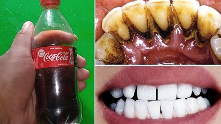 coca cola pour blanchir les dents