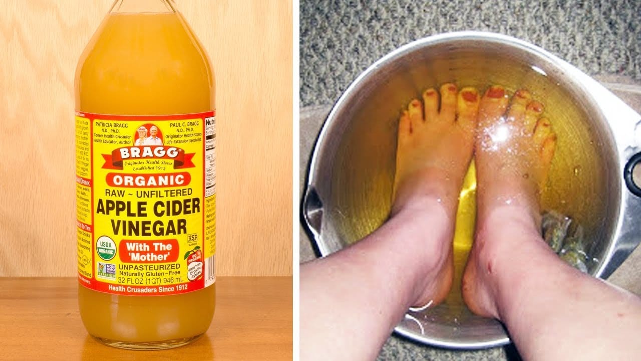 vinaigre de cidre de pomme traiter pied d'athlète
